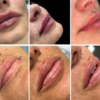 Preenchimento Labial